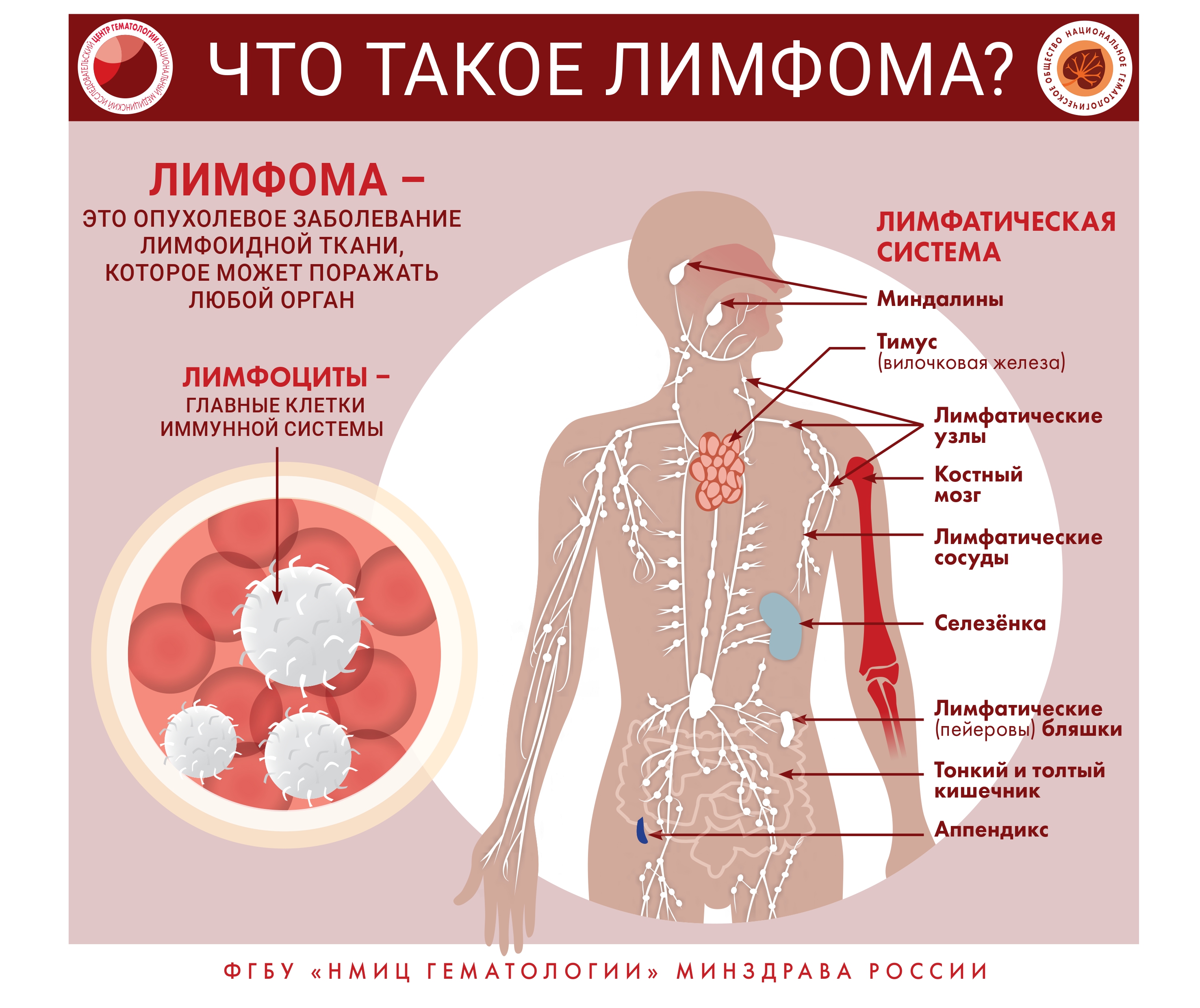 Неходжкинская лимфома картина крови